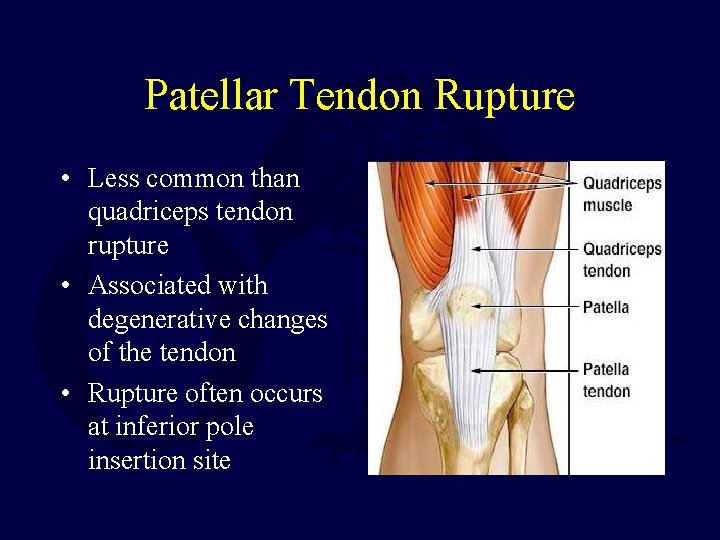 Patellar Tendon Rupture • Less common than quadriceps tendon rupture • Associated with degenerative