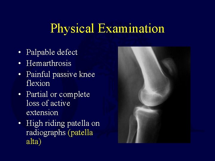 Physical Examination • Palpable defect • Hemarthrosis • Painful passive knee flexion • Partial