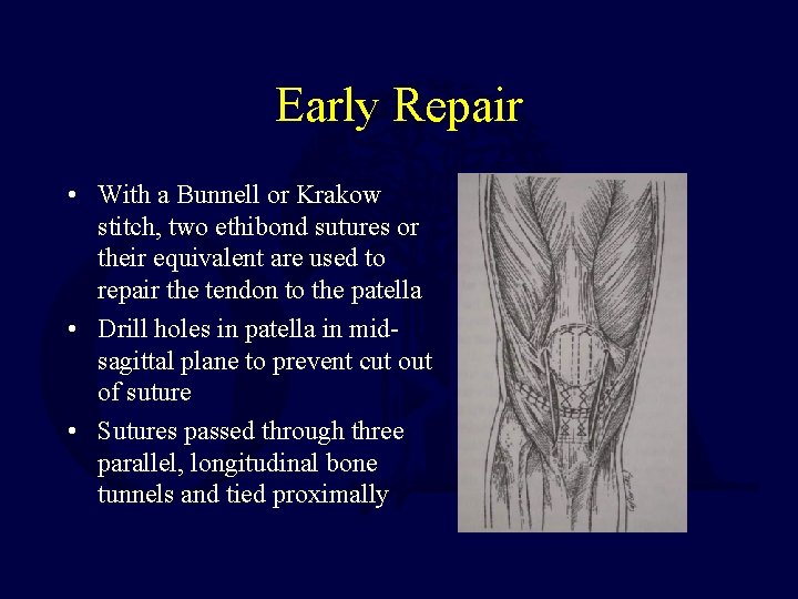 Early Repair • With a Bunnell or Krakow stitch, two ethibond sutures or their