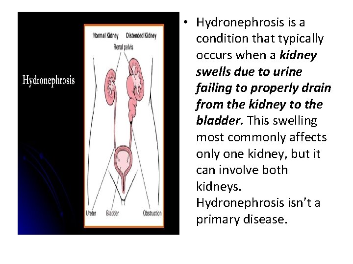  • Hydronephrosis is a condition that typically occurs when a kidney swells due