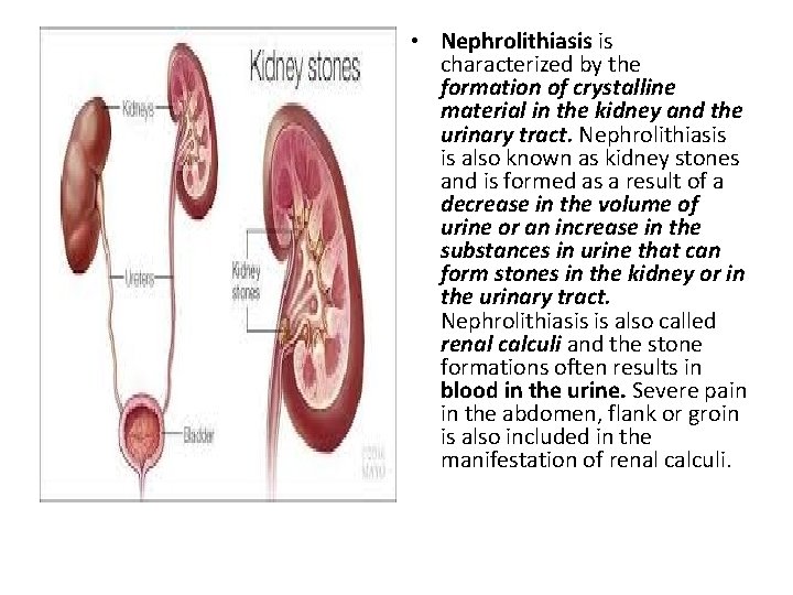  • Nephrolithiasis is characterized by the formation of crystalline material in the kidney