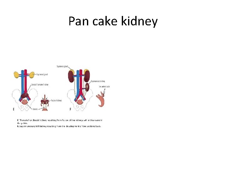 Pan cake kidney 