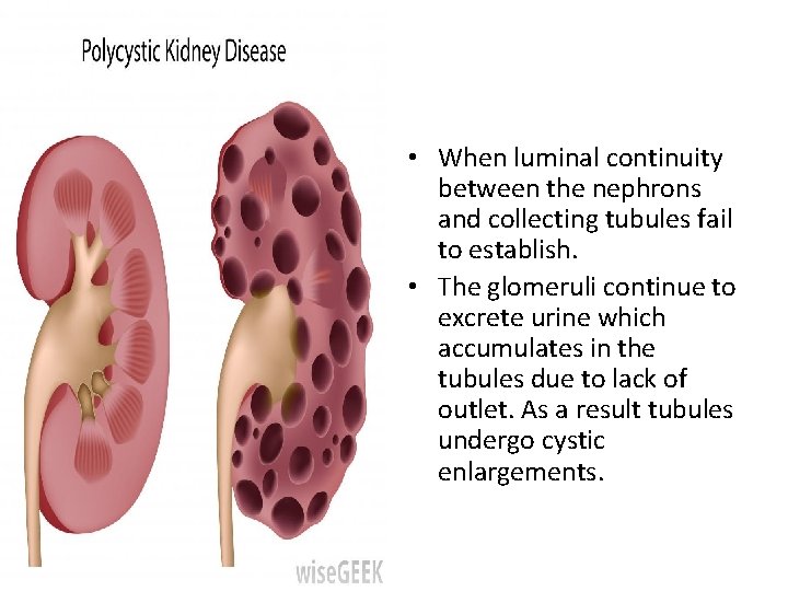  • When luminal continuity between the nephrons and collecting tubules fail to establish.