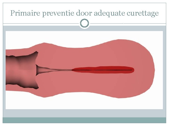 Primaire preventie door adequate curettage 