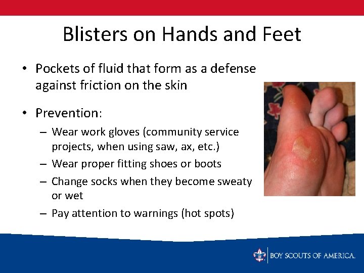 Blisters on Hands and Feet • Pockets of fluid that form as a defense