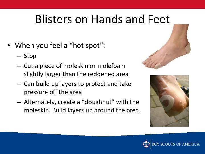 Blisters on Hands and Feet • When you feel a “hot spot”: – Stop