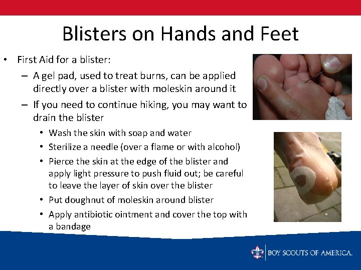 Blisters on Hands and Feet • First Aid for a blister: – A gel