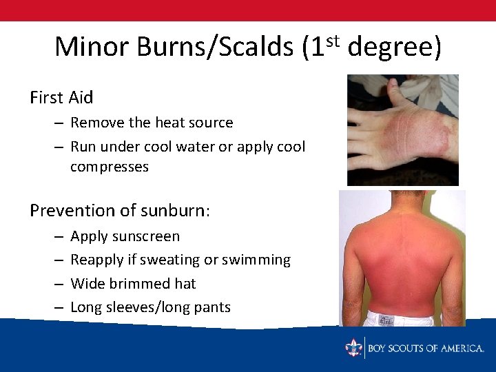 Minor Burns/Scalds (1 st degree) First Aid – Remove the heat source – Run