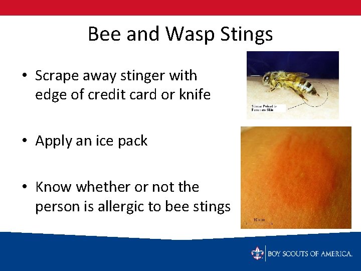 Bee and Wasp Stings • Scrape away stinger with edge of credit card or