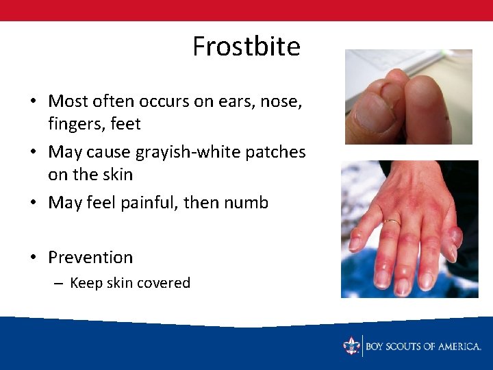Frostbite • Most often occurs on ears, nose, fingers, feet • May cause grayish-white