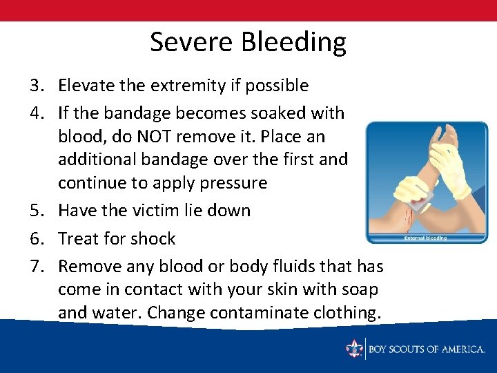 Severe Bleeding 3. Elevate the extremity if possible 4. If the bandage becomes soaked