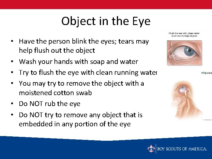 Object in the Eye • Have the person blink the eyes; tears may help