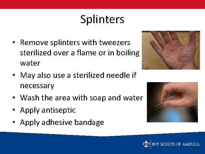 Splinters • Remove splinters with tweezers sterilized over a flame or in boiling water