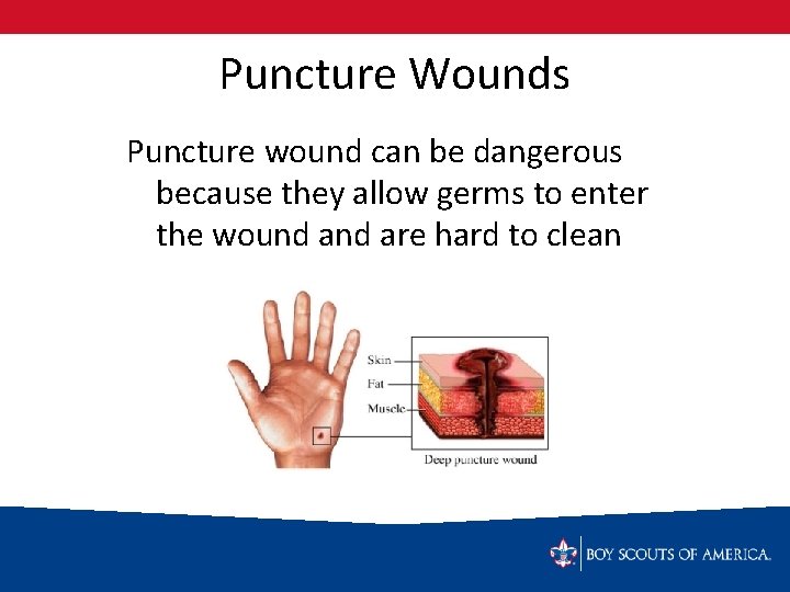 Puncture Wounds Puncture wound can be dangerous because they allow germs to enter the