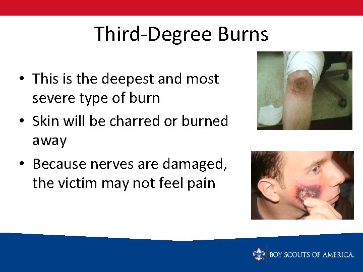 Third-Degree Burns • This is the deepest and most severe type of burn •