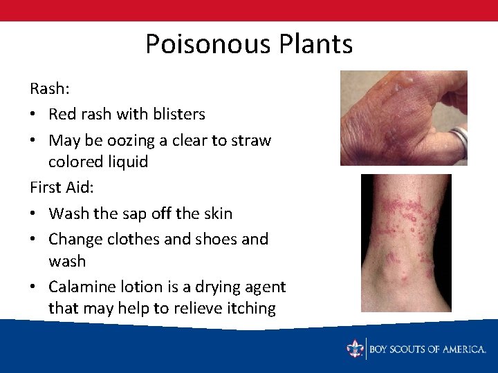 Poisonous Plants Rash: • Red rash with blisters • May be oozing a clear