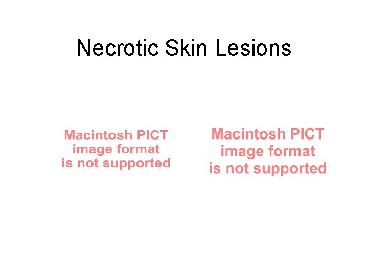 Necrotic Skin Lesions 