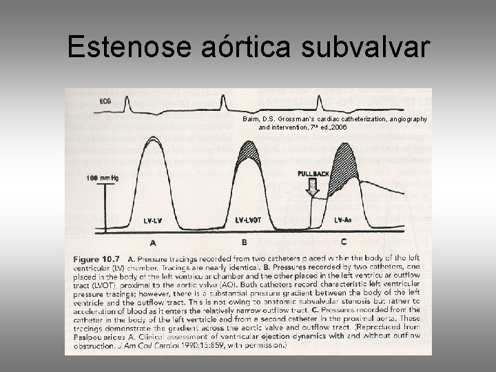 Estenose aórtica subvalvar Baim, D. S. Grossman`s cardiac catheterization, angiography and intervention, 7 th