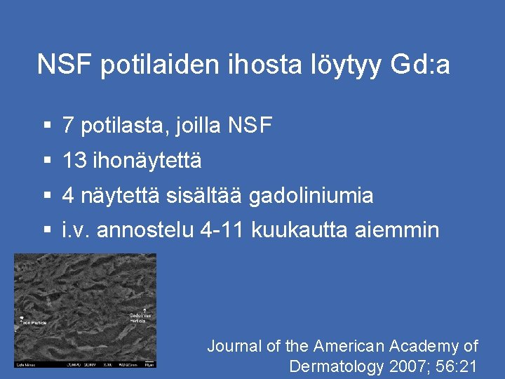 NSF potilaiden ihosta löytyy Gd: a § 7 potilasta, joilla NSF § 13 ihonäytettä