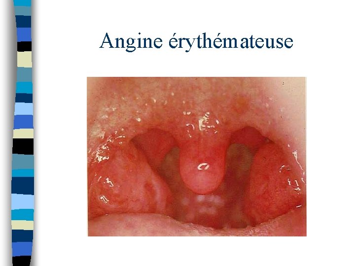 Angine érythémateuse Angine érythémateuse