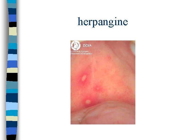 herpangine herpangine