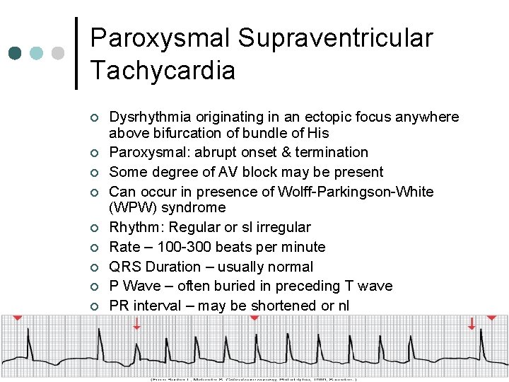 Paroxysmal Supraventricular Tachycardia ¢ ¢ ¢ ¢ ¢ Dysrhythmia originating in an ectopic focus
