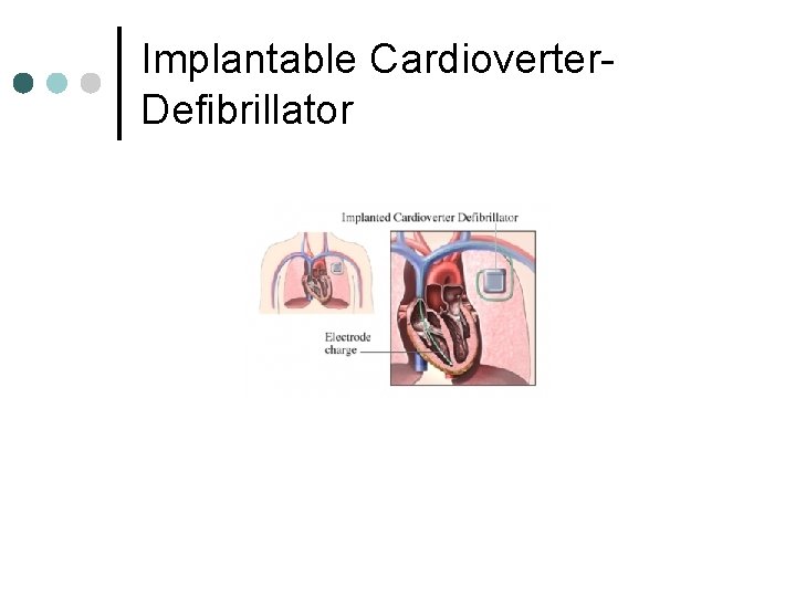 Implantable Cardioverter. Defibrillator 