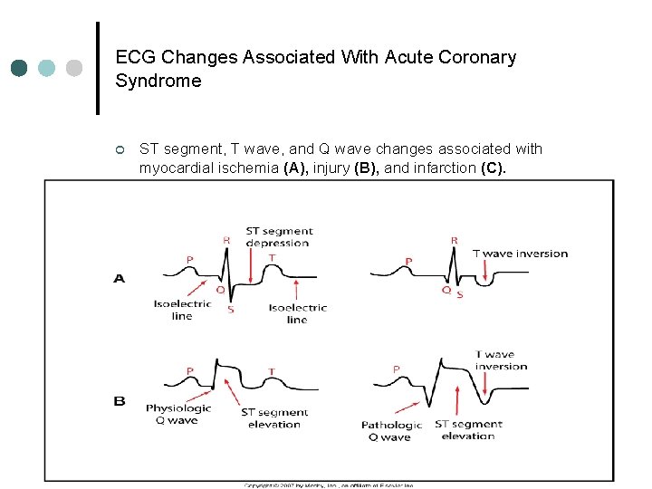 ECG Changes Associated With Acute Coronary Syndrome ¢ ST segment, T wave, and Q