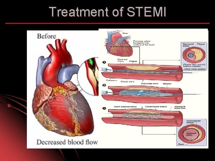 Treatment of STEMI 