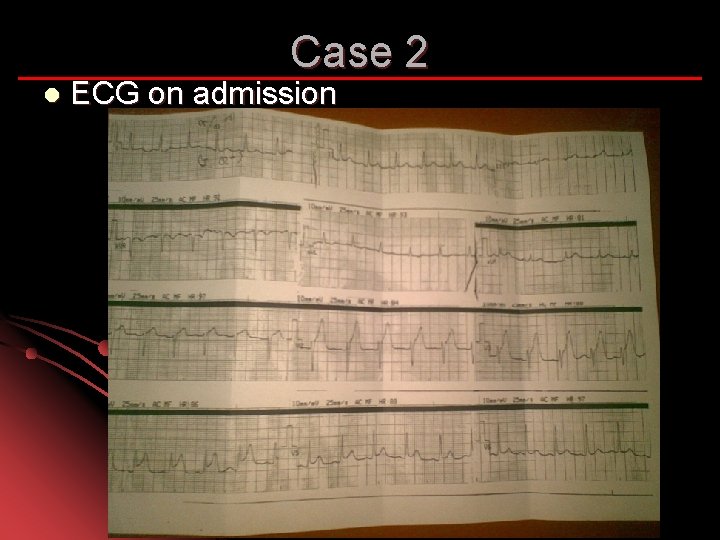 Case 2 l ECG on admission 