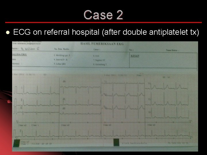 Case 2 l ECG on referral hospital (after double antiplatelet tx) 