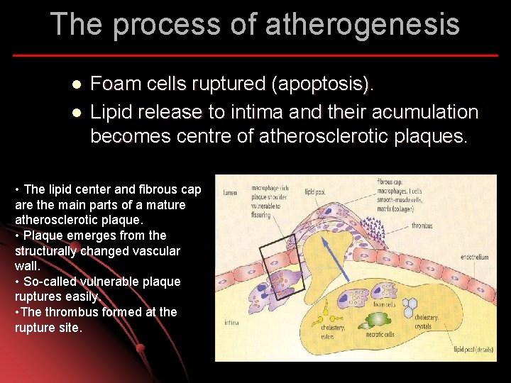 The process of atherogenesis l l Foam cells ruptured (apoptosis). Lipid release to intima