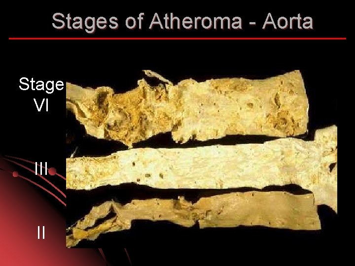 Stages of Atheroma - Aorta Stage VI II 