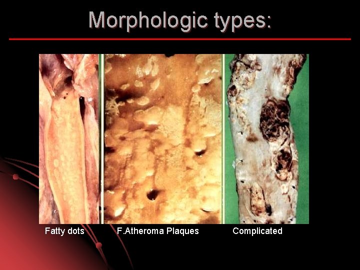 Morphologic types: Fatty dots F. Atheroma Plaques Complicated 