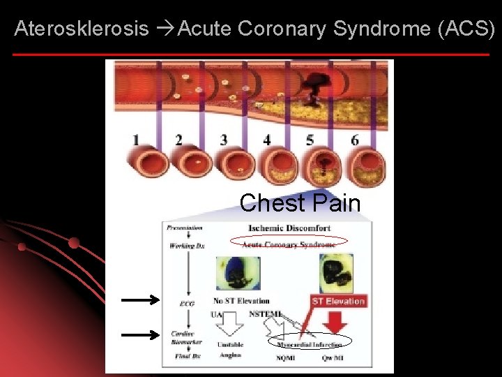 Aterosklerosis Acute Coronary Syndrome (ACS) Chest Pain 
