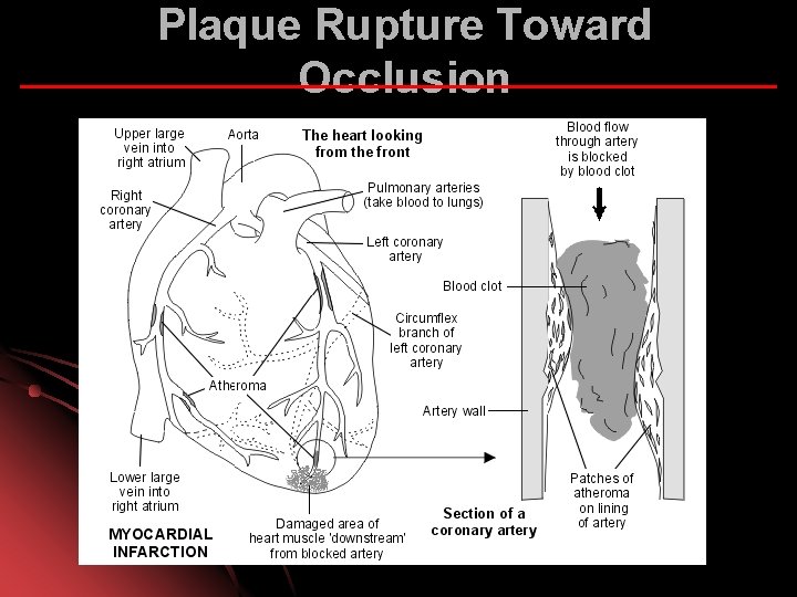 Plaque Rupture Toward Occlusion 