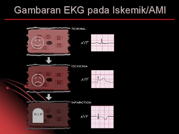 Gambaran EKG pada Iskemik/AMI 