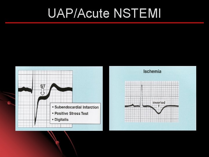 UAP/Acute NSTEMI 