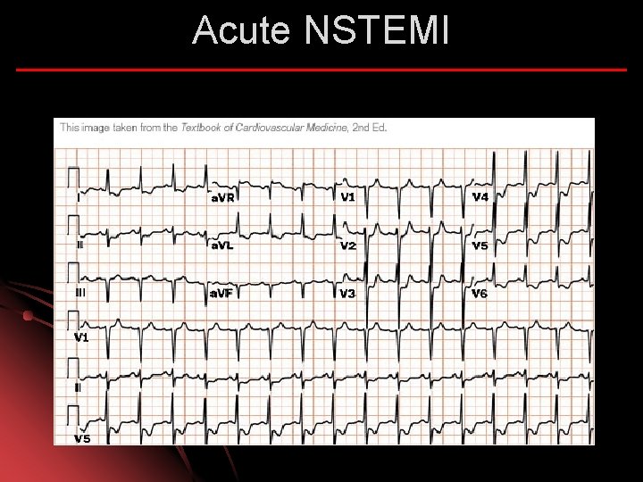 Acute NSTEMI 