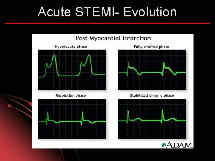 Acute STEMI- Evolution 