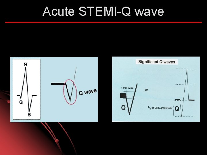 Acute STEMI-Q wave 