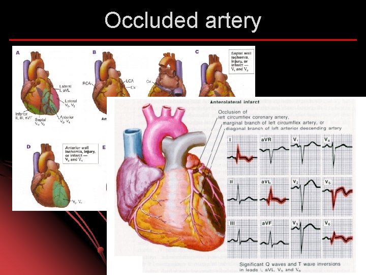 Occluded artery 