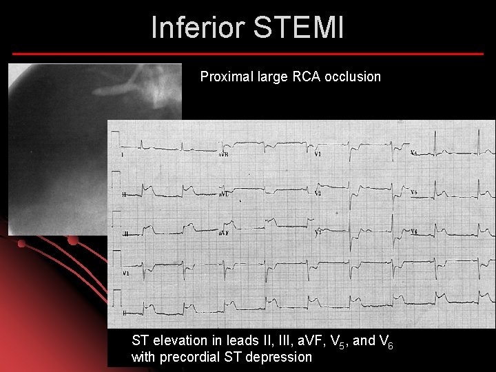 Inferior STEMI Proximal large RCA occlusion ST elevation in leads II, III, a. VF,
