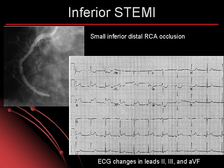 Inferior STEMI Small inferior distal RCA occlusion ECG changes in leads II, III, and