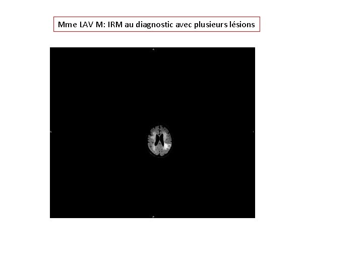 Mme LAV M: IRM au diagnostic avec plusieurs lésions 