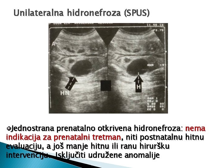 Unilateralna hidronefroza (SPUS) Jednostrana prenatalno otkrivena hidronefroza: nema indikacija za prenatalni tretman, niti postnatalnu