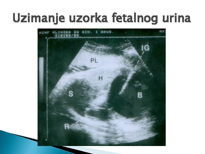 Uzimanje uzorka fetalnog urina 