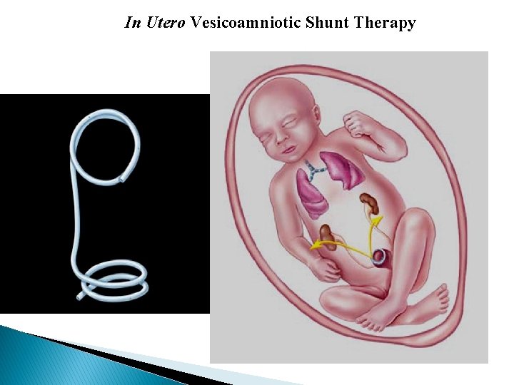 In Utero Vesicoamniotic Shunt Therapy 