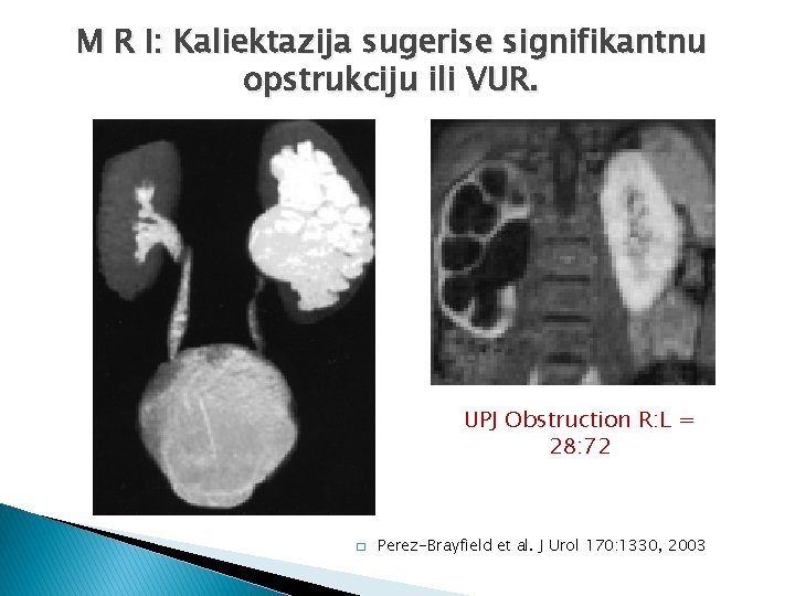 M R I: Kaliektazija sugerise signifikantnu opstrukciju ili VUR. UPJ Obstruction R: L =