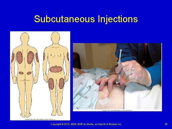 Subcutaneous Injections Copyright © 2013, 2009, 2005 by Mosby, an imprint of Elsevier Inc.